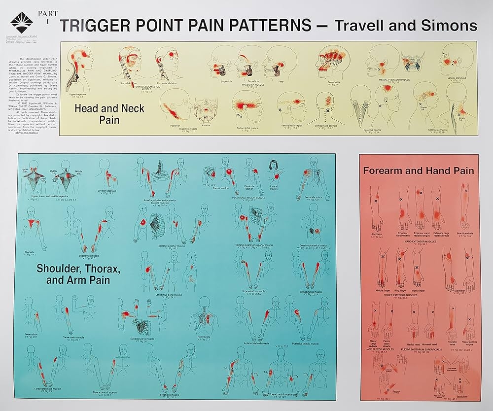 Trigger Points Of Pain Wall Charts Set Of 2 