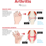 Rheumatoid Arthritis Infographic Templates