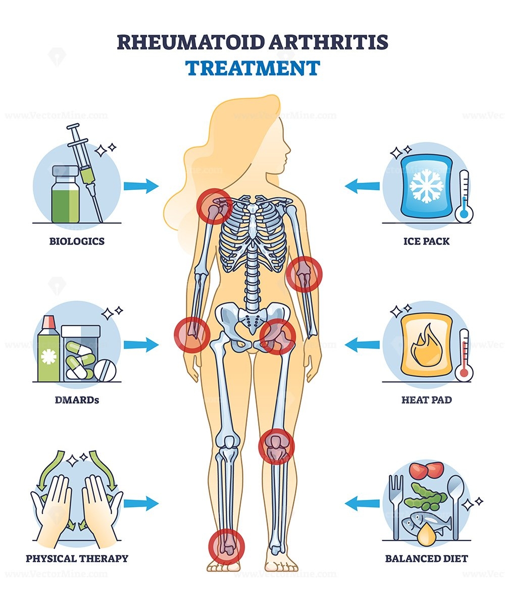 Rheumatoid Arthritis Treatment And Health Therapy Methods Outline Diagram VectorMine