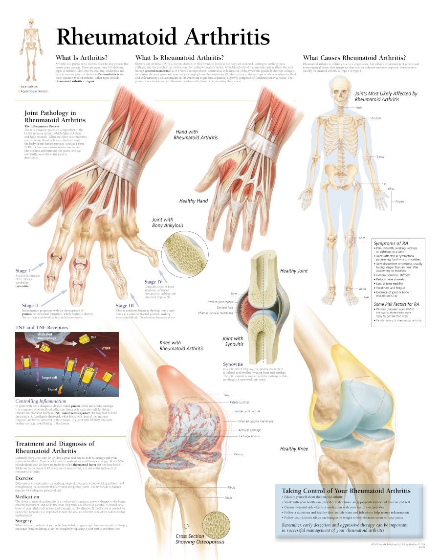 Scientific Publishing Rheumatoid Arthritis Chart